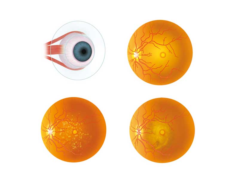 Rhodopsin gene mutation analysis in Iranian patients with autosomal dominant retinitis pigmentosa 